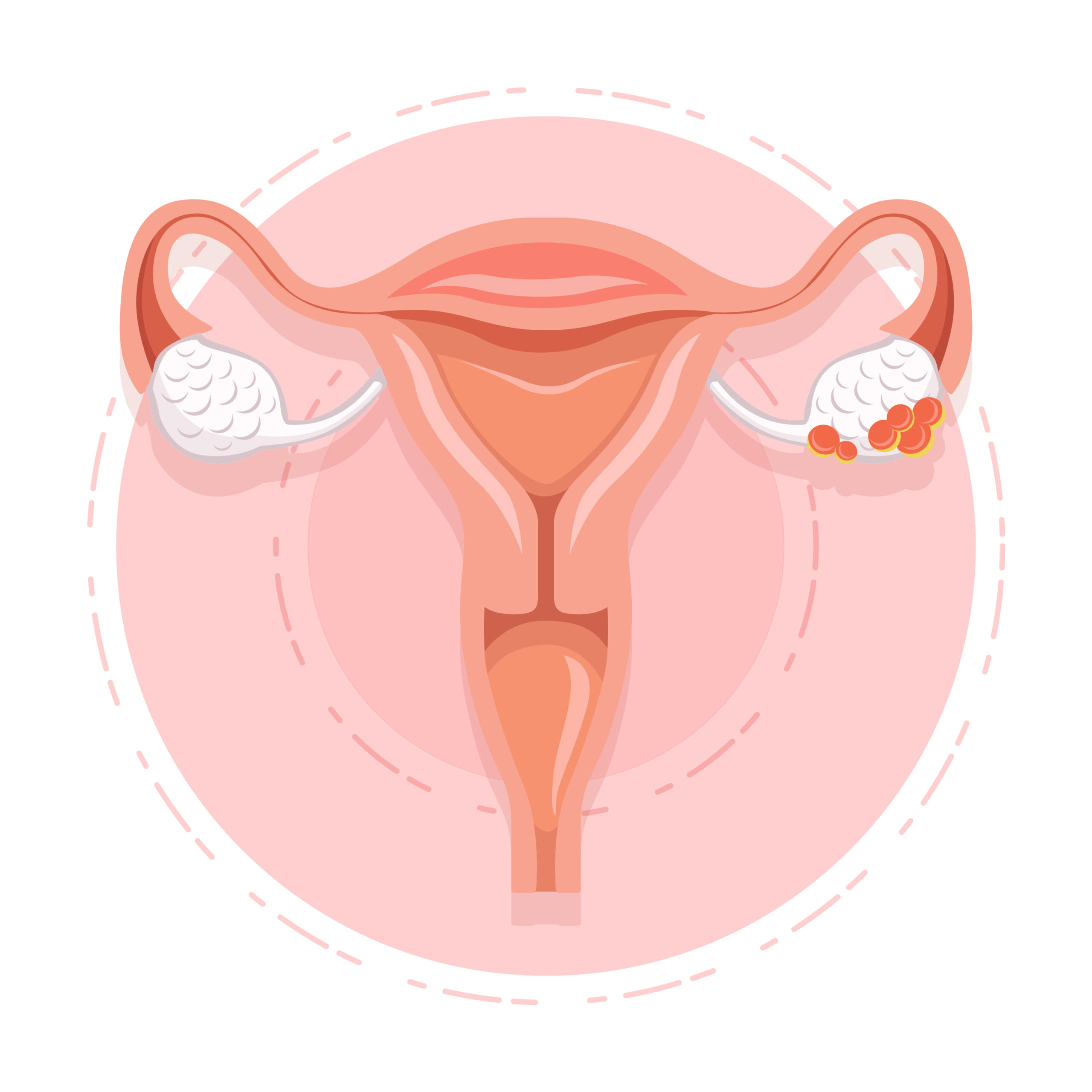 Ovary_Cancer_Vector_Art