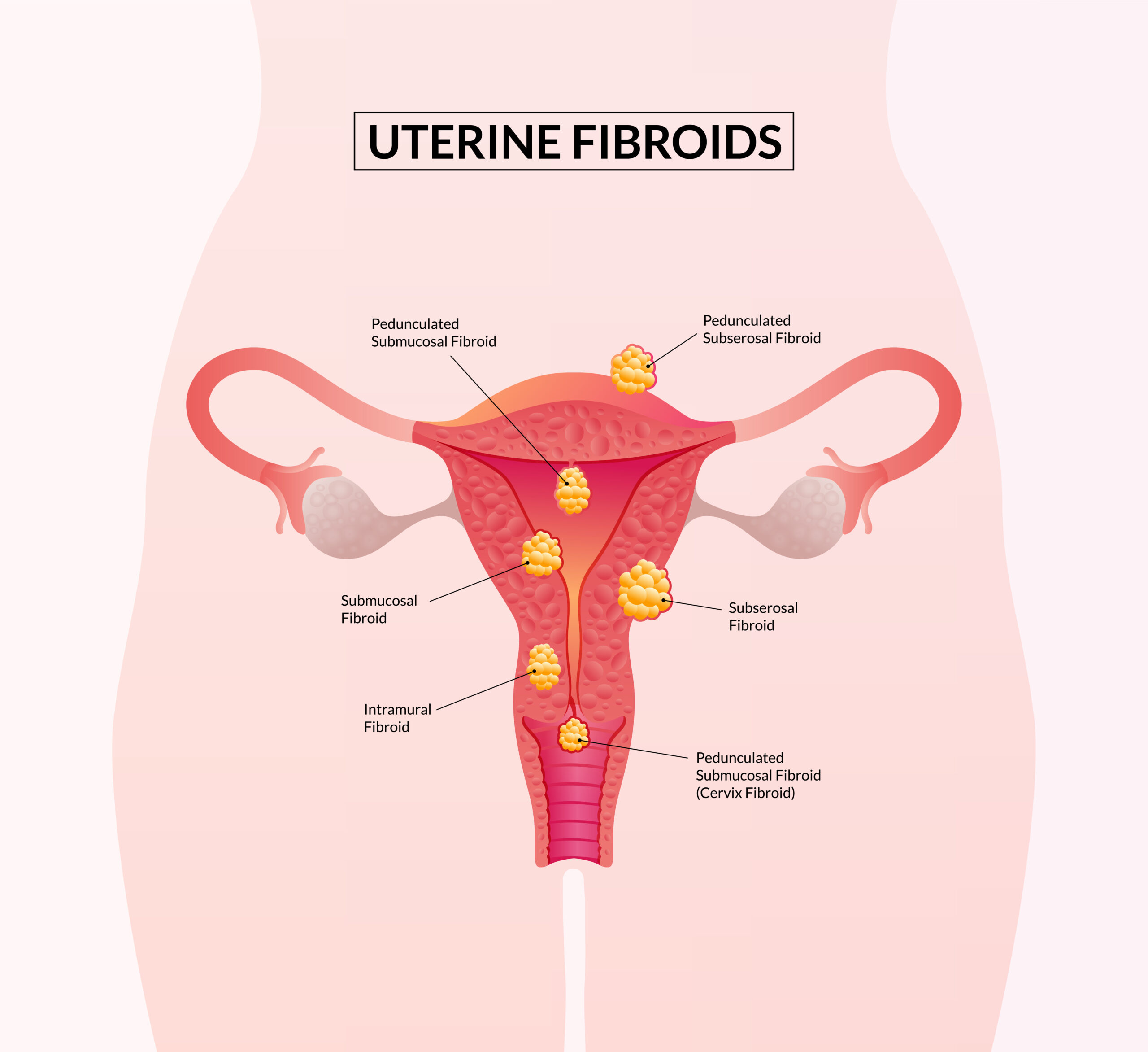 Uterine fibroids after menopause