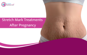 Effective Treatments for Stretch Marks After Pregnancy